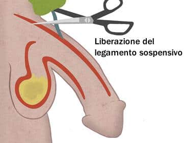 Interventi chirurgici per aumentare la lunghezza del pene