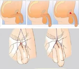 Allungamento del pene tramite chirurgia